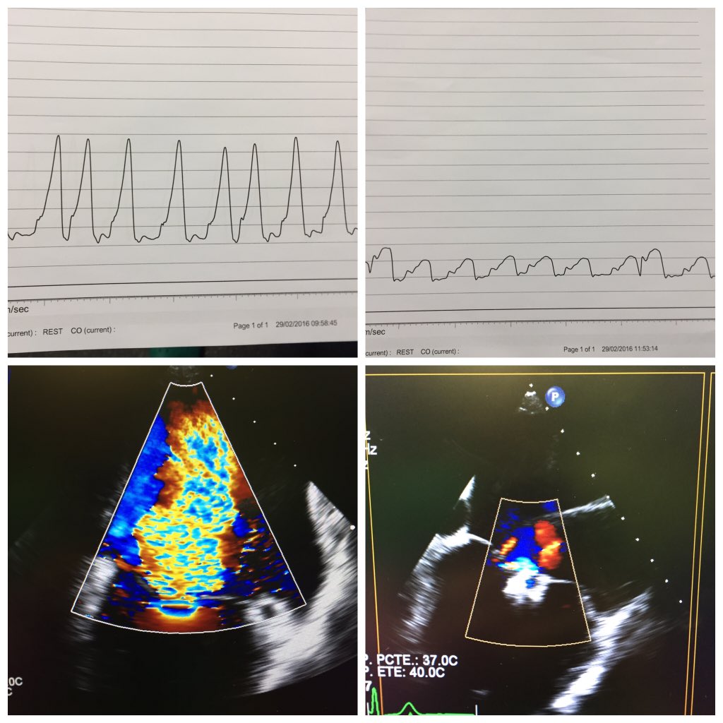 RodrigoEstvez1's tweet photo. Successful pmvr with 2 #Mitraclips in DMR. Look at LA pressure @jose_lezo @MPAOSS @srdeleiras https://t.co/GDflIKxFtB