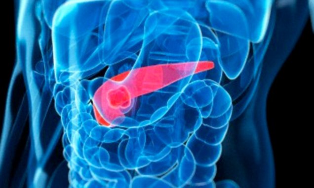 DrRandyMartin1's tweet photo. Could determining that pancreatic cancer is four diseases help with treatment? https://t.co/rjlR49Sej4 https://t.co/qx7N9eQTCw