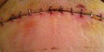 daniekaye1's tweet photo. #FDA #Bayer #BAYN #BAYRY Rash Catheter Pills 5 surgeries 2 remove ur poison #Essure #EssureProblems #BoycottBayer https://t.co/vGrArOhS4M