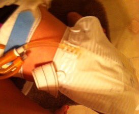 daniekaye1's tweet photo. #FDA #Bayer #BAYN #BAYRY Rash Catheter Pills 5 surgeries 2 remove ur poison #Essure #EssureProblems #BoycottBayer https://t.co/vGrArOhS4M