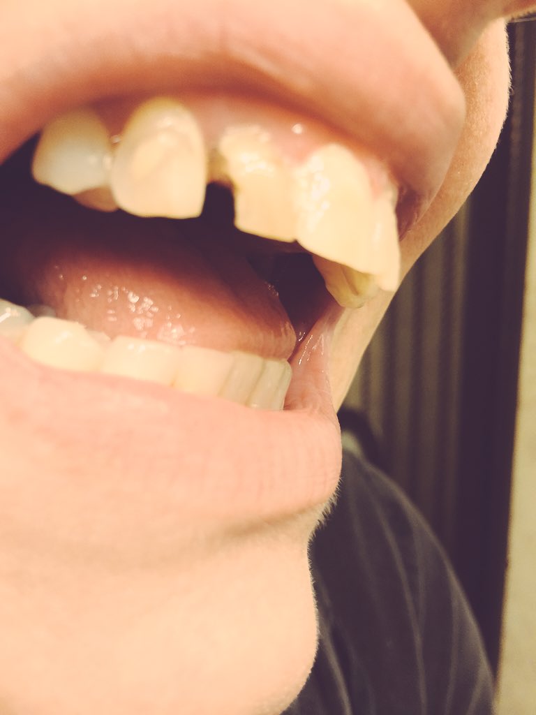 daniekaye1's tweet photo. #FDA #Bayer #BAYN #BAYRY Thx 2 #Essure my teeth became unrepairable 26k 2 have teeth again #EssureProblems #poison https://t.co/zBbeU1iq5g