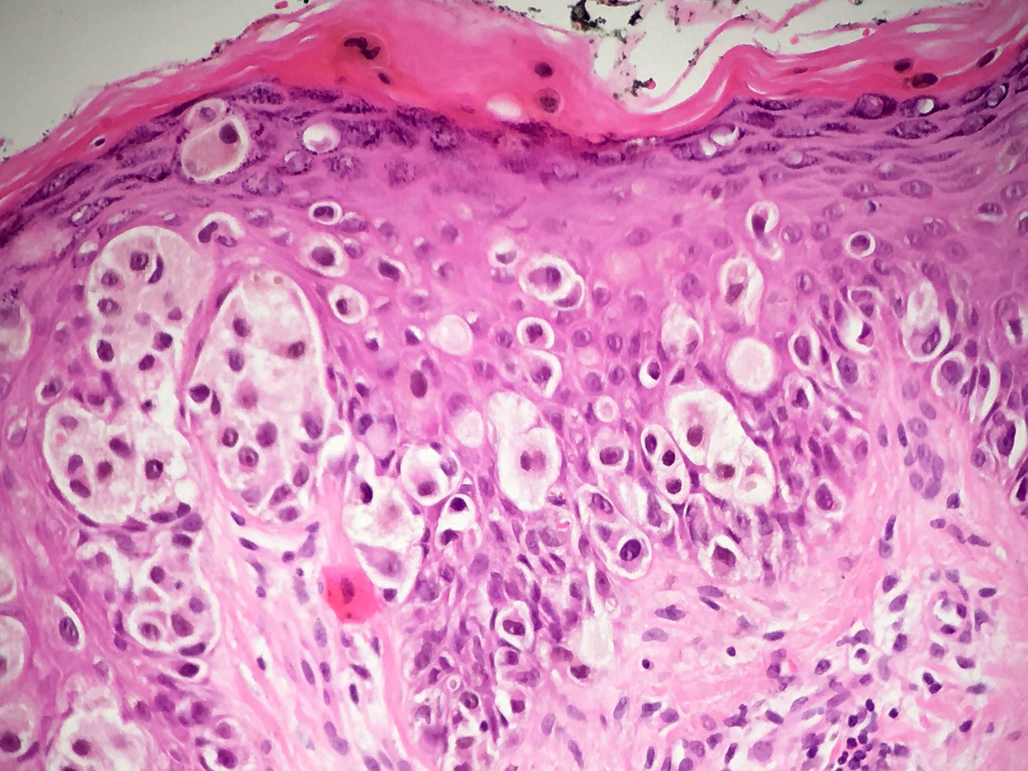 superficial spreading malignant melanoma