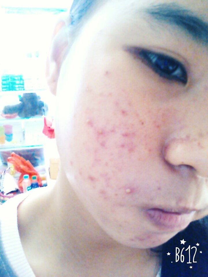 raversofckrwg's tweet photo. @Theo_Liow tuh dok hbs fcial bskny timbul jrwt ky gt:( gmn ya https://t.co/kn3IWq6lFN