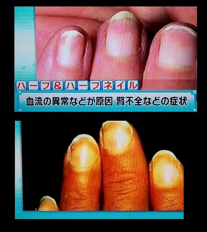 爪半月 爪半月
