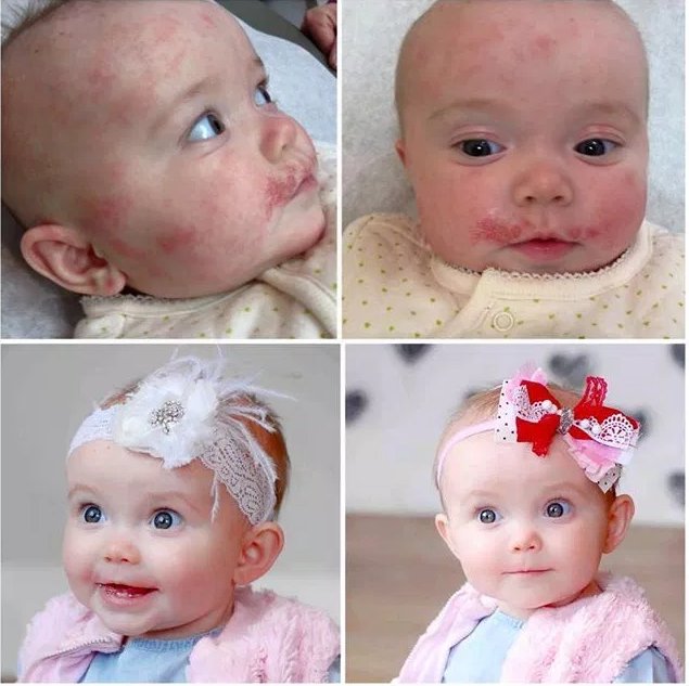 cherylleemd's tweet photo. Give your baby relief. We can help. #TrueLipids #eczema #eczemarelief READ Sadie's story https://t.co/GASEZkPQRq https://t.co/R2a5JXtL0K