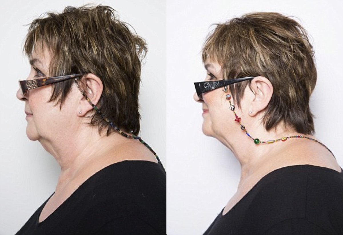 SkinAssociates's tweet photo. Introductory offer on our NEW treatment... Cryotherapy for double chins! 
WAS £150 NOW £99
goodbye double chin! https://t.co/XUu2GUrWfG