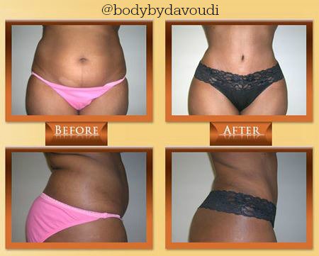 DrDavoudi's tweet photo. Incredible #tummytuck from one of the best #PlasticSurgeons in town! Call (770) 418-1234 to schedule a consultation! https://t.co/pkmCZjGS4L
