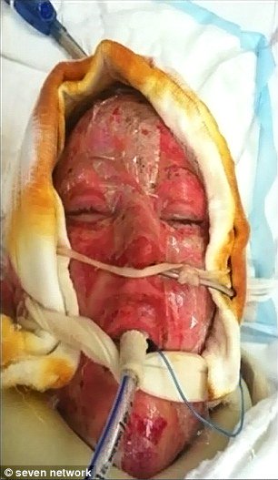 This Girl Removed Her Mask After 2 Years..These 9 Photos Will Leave You Speechless => bit.ly/1LCk6cT