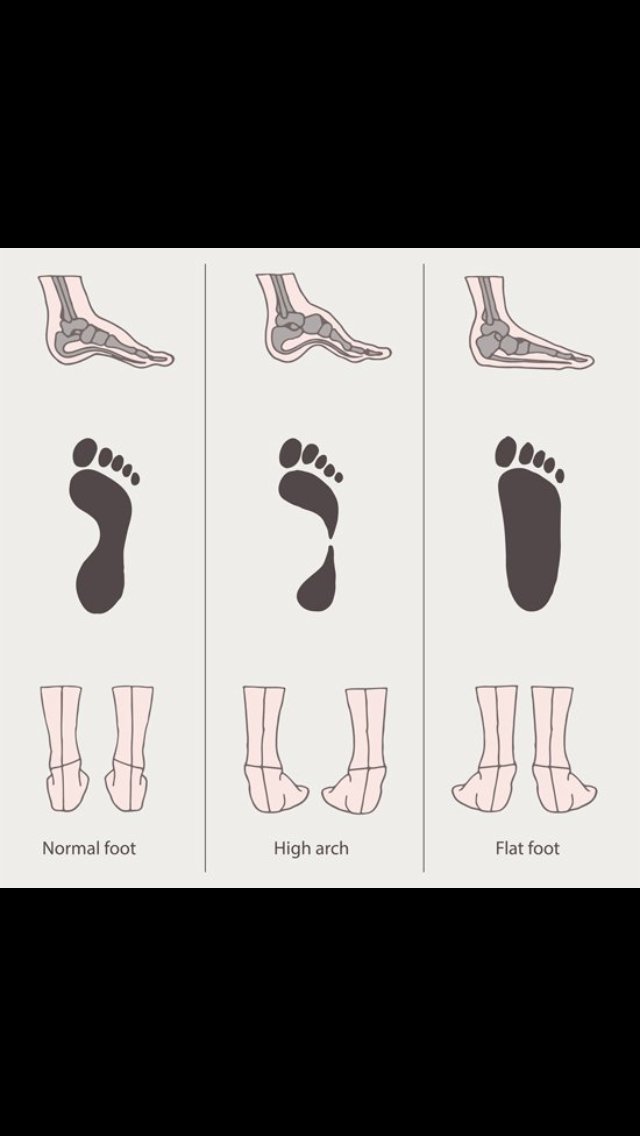 CityPodiatryNYC's tweet photo. Which #foottype are you? #normal, #higharch, or #flatfoot https://t.co/1SQP0VQqEi