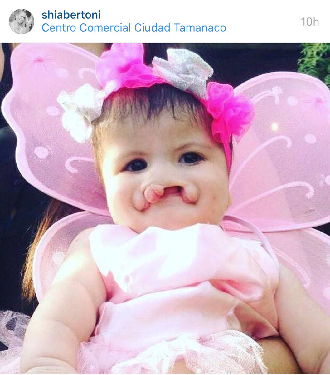 Carlos_jvr11's tweet photo. Esta es mi angelito Eva Lucía. Debido a unos patrones mal formados en la genética de sus padres. Ella nació así. https://t.co/rj65ntgEix