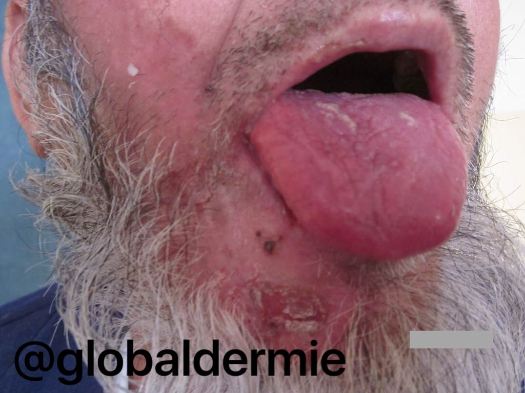 globaldermie's tweet photo. 55yo Asia otalgia &amp; mild facial palsy #RamsayHunt #shingles #zoster #geniculate #varicella #dermatology #globalderm https://t.co/X5w5kaDTLe