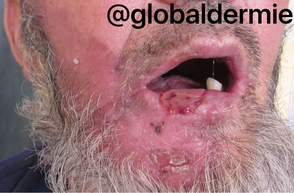 globaldermie's tweet photo. 55yo Asia otalgia &amp; mild facial palsy #RamsayHunt #shingles #zoster #geniculate #varicella #dermatology #globalderm https://t.co/X5w5kaDTLe