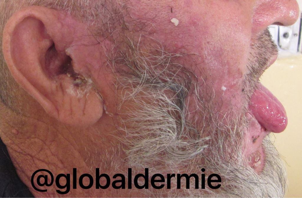 globaldermie's tweet photo. 55yo Asia otalgia &amp; mild facial palsy #RamsayHunt #shingles #zoster #geniculate #varicella #dermatology #globalderm https://t.co/X5w5kaDTLe