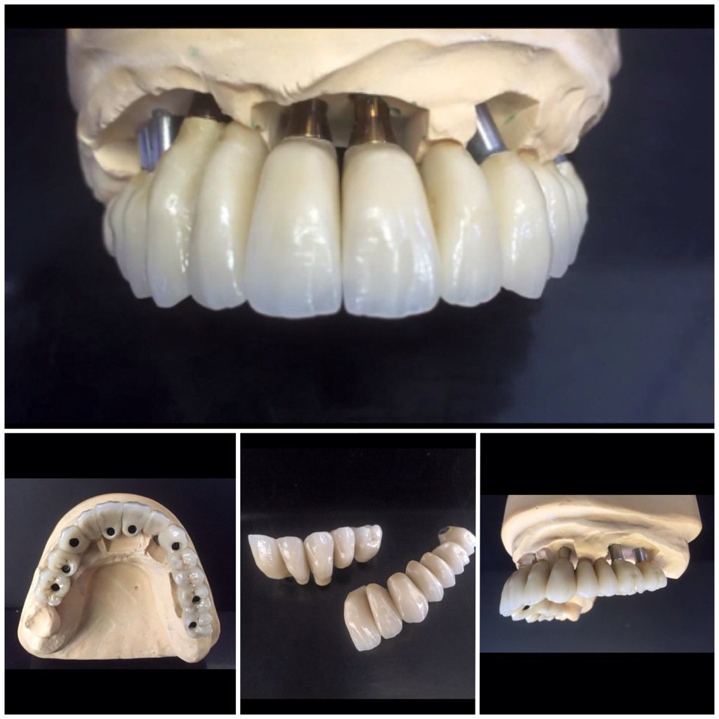 DSDdentallab's tweet photo. 12 unit #createch #CAD/CAM porcelain Bridge! #dentistry #dental #dsddental #implants https://t.co/Ax6t8J9lco