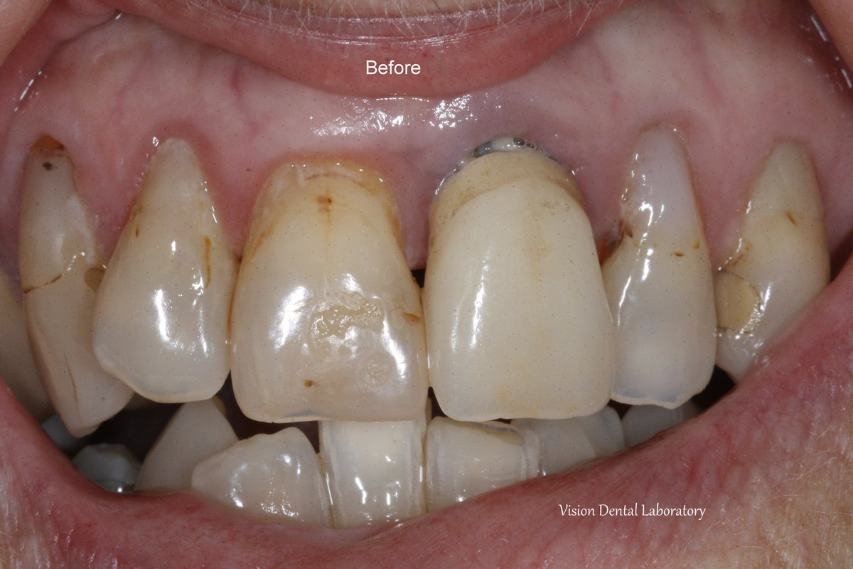 visiondentalab's tweet photo. Emax crown.  To match shade and character of existing anterior teeth. https://t.co/mxxvOFGje2