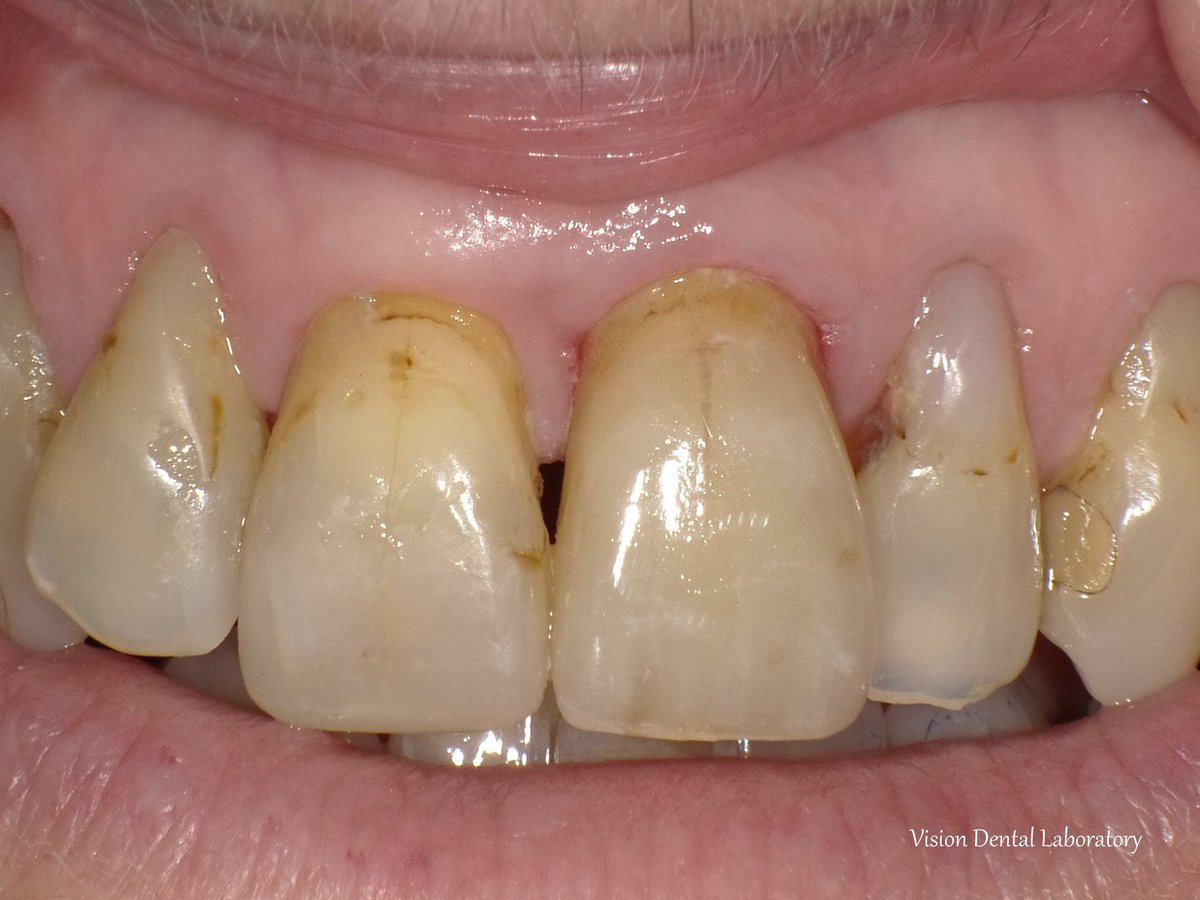 visiondentalab's tweet photo. Emax crown.  To match shade and character of existing anterior teeth. https://t.co/mxxvOFGje2