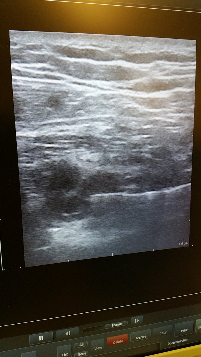 sidsata's tweet image. Sweet #raptir block this morning at #DukeRAP @Duke_Anesthesia