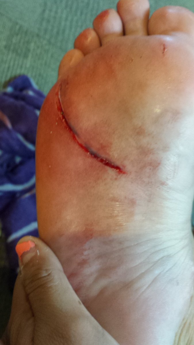 blackfeather12's tweet photo. Went outside and this happened.  :/  #neverdoingthatagain #stoplittering #ouch https://t.co/f45eIs0DUC