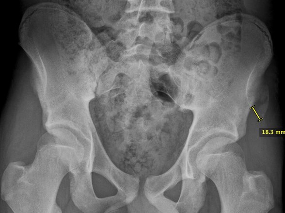 ballaratortho's tweet photo. New Blog today from Mr David Mitchell: Adolescent pelvic avulsion fractures.
Read more here: https://t.co/j7sSZXMWHD https://t.co/yRTQc3PpGi