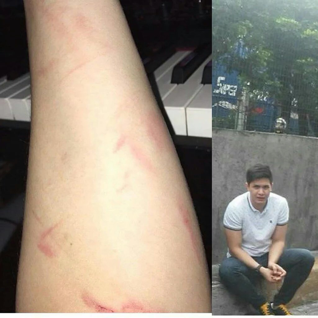 CindyHarvard's tweet photo. Pls dont be sad ADN. This wounds or scars to be is d definition of a real man. He's a brave man  #ALDUBRegaloNiLola https://t.co/NnIGUvnFxk