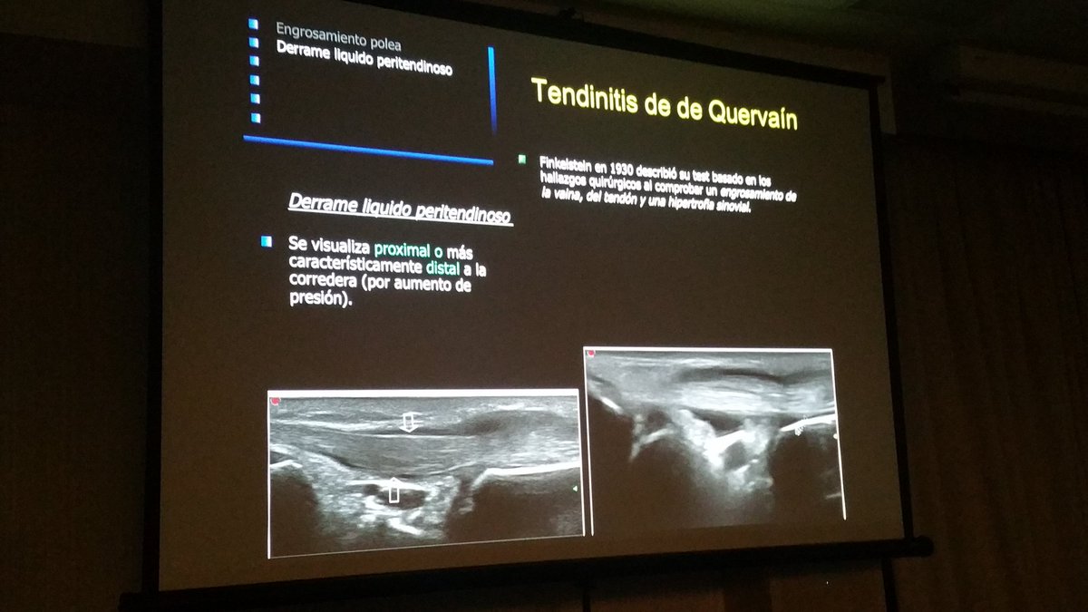 carlespedret's tweet image. De Quervain tendinopathy. Pulley hypertrophy and proximal swelling #ECOARS