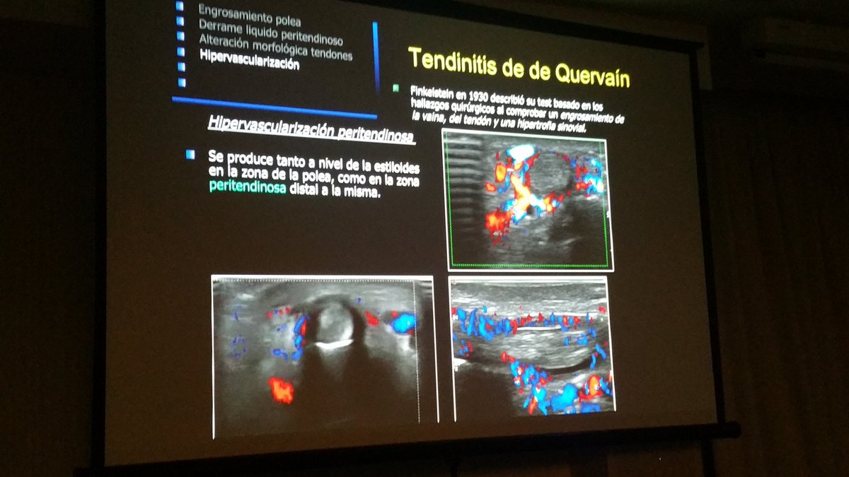 carlespedret's tweet image. And neovessels in power doppler #ECOARS