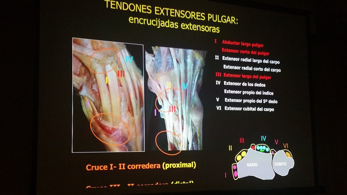 carlespedret's tweet image. Crossover syndrome between 1st and 2nd dorsal channels of the wrist #ECOARS