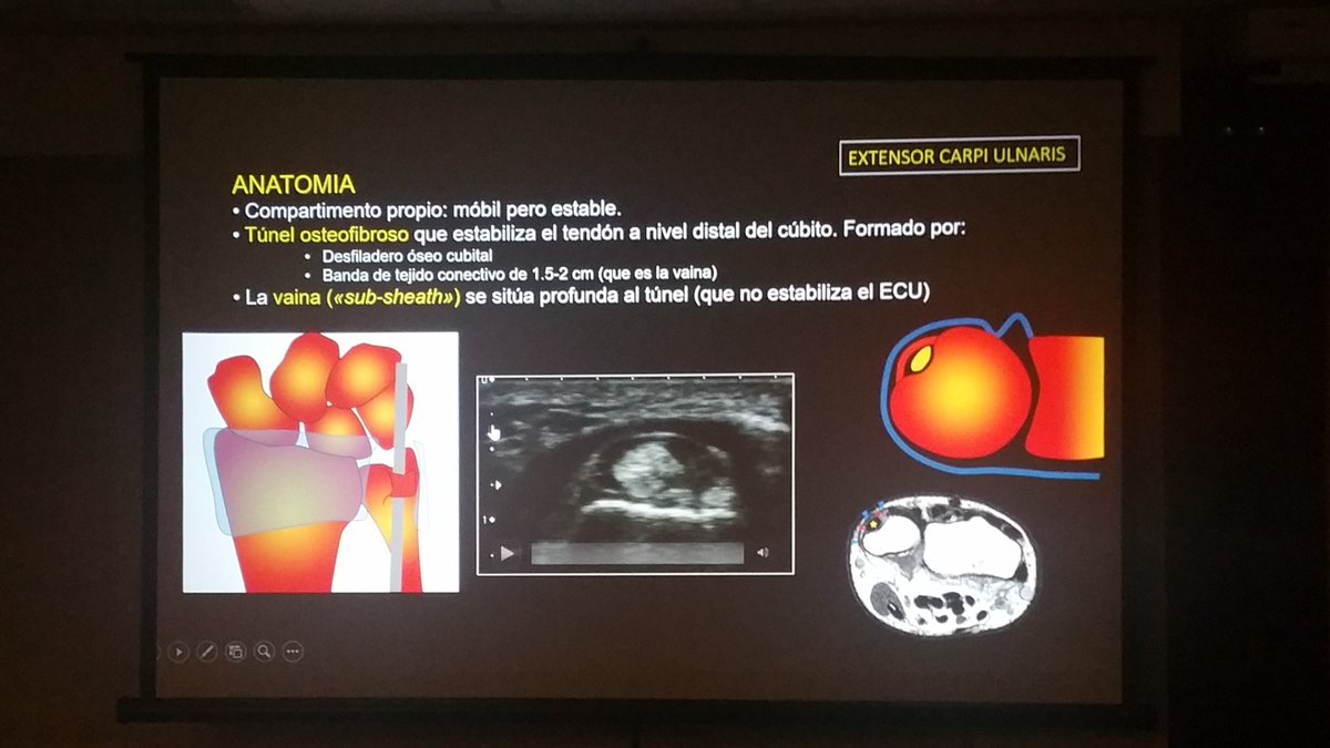 carlespedret's tweet image. Sonoanatomy of the extensor carpi ulnaris complex #ECOARS