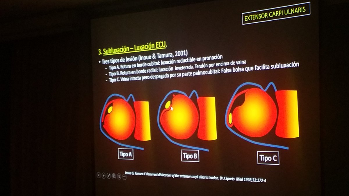 carlespedret's tweet image. 3 different types of ECU subluxation  / luxation #ECOARS