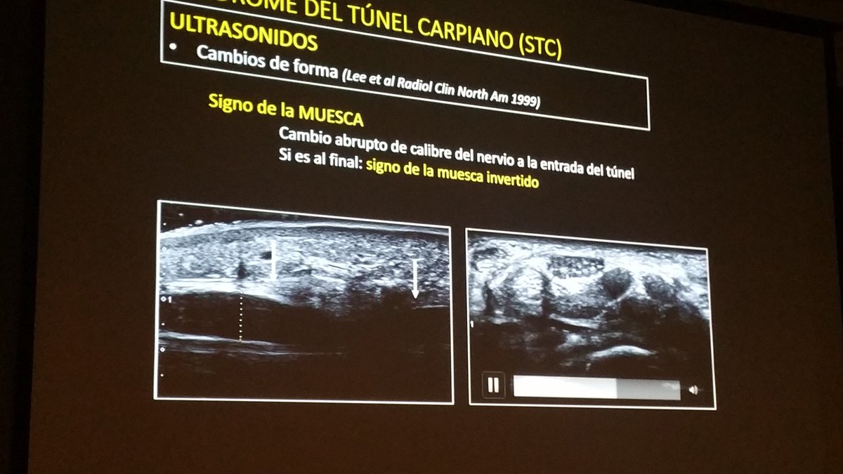 carlespedret's tweet image. Carpal tunnel syndrome. Hypertrophy of the median nerve in #ultrasound #ECOARS  Dr. Balius