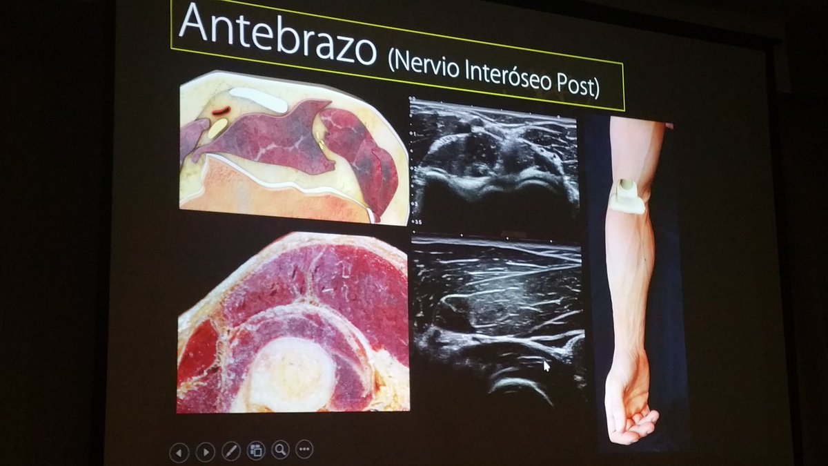 carlespedret's tweet image. Posterior interosseus nerve in the forearm @inigoiri #ECOARS