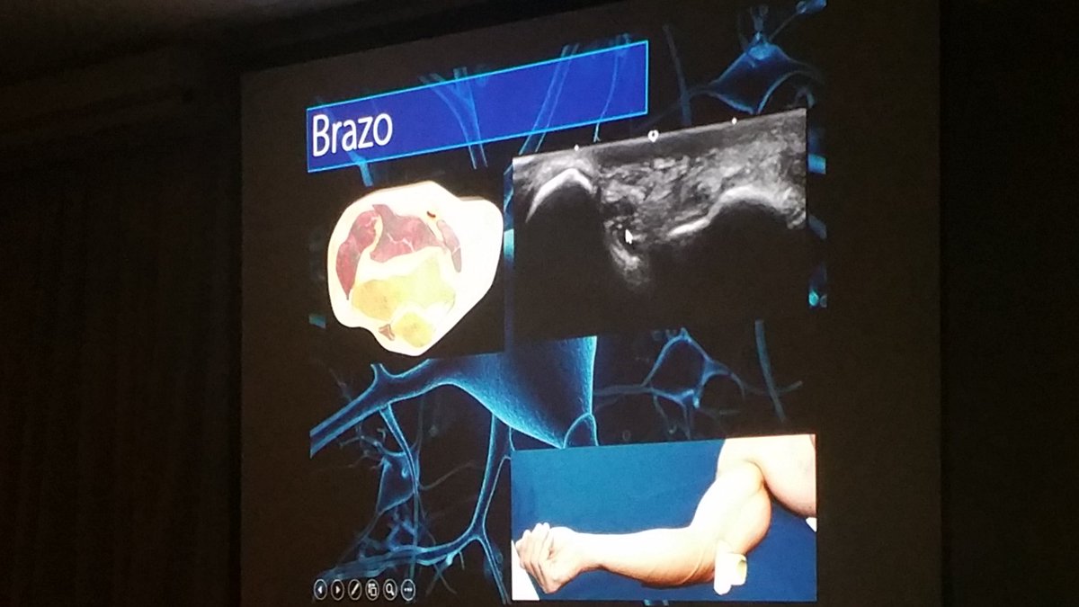 carlespedret's tweet image. Cubital nerve in the elbow @inigoiri #ECOARS