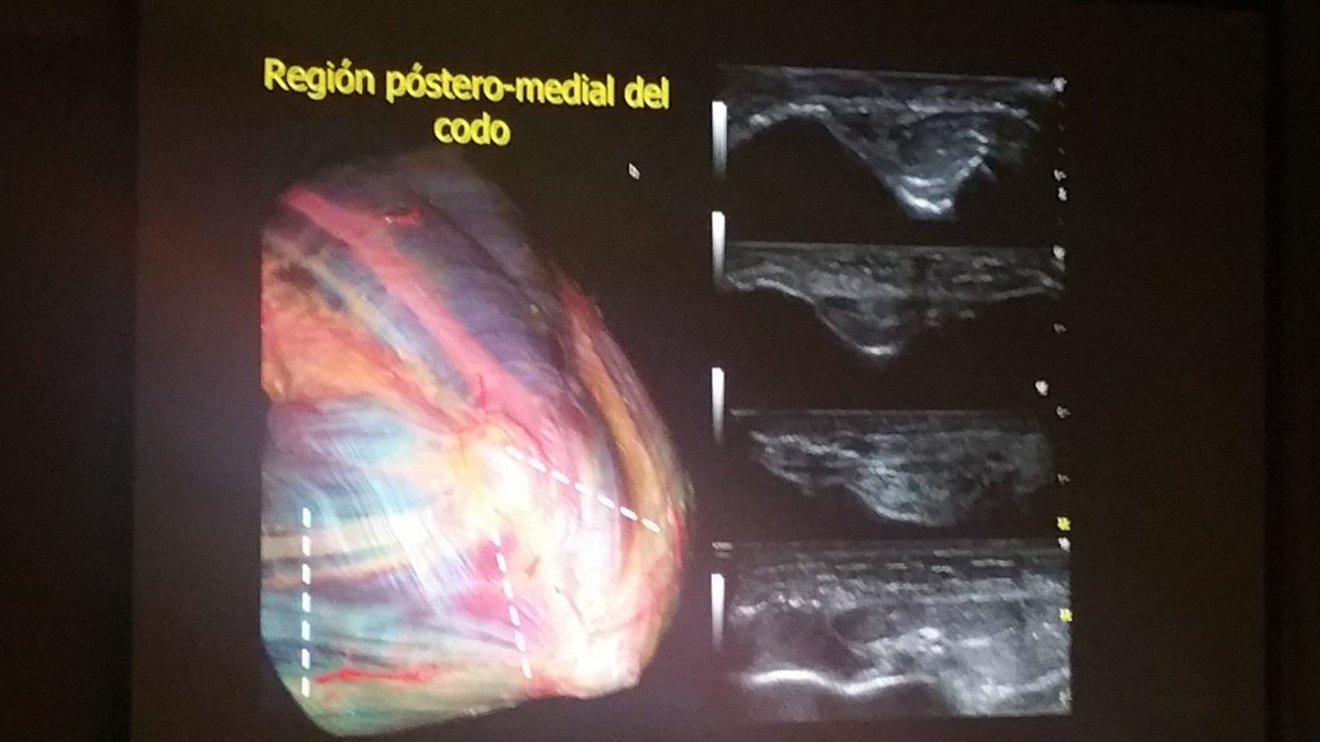 carlespedret's tweet image. Nerve #ultrasound  and pathology in the elbow, forearm, wrist and hand. HIGH LEVEL!! In #ECOARS