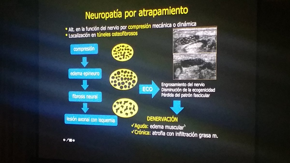 carlespedret's tweet image. Entrapment neuropathy in #ultrasound #ECOARS