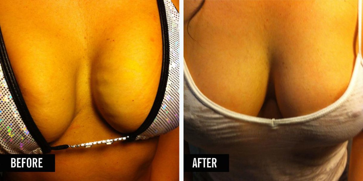 FaceliftVampire's tweet photo. Women Are Getting Vampire Breast Lifts to Plump Their Boobs @Cosmopolitan #plasticsurgery https://t.co/bFlRWDgxVN https://t.co/iqFtLhCapJ