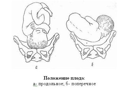 Положение плода в матке продольное