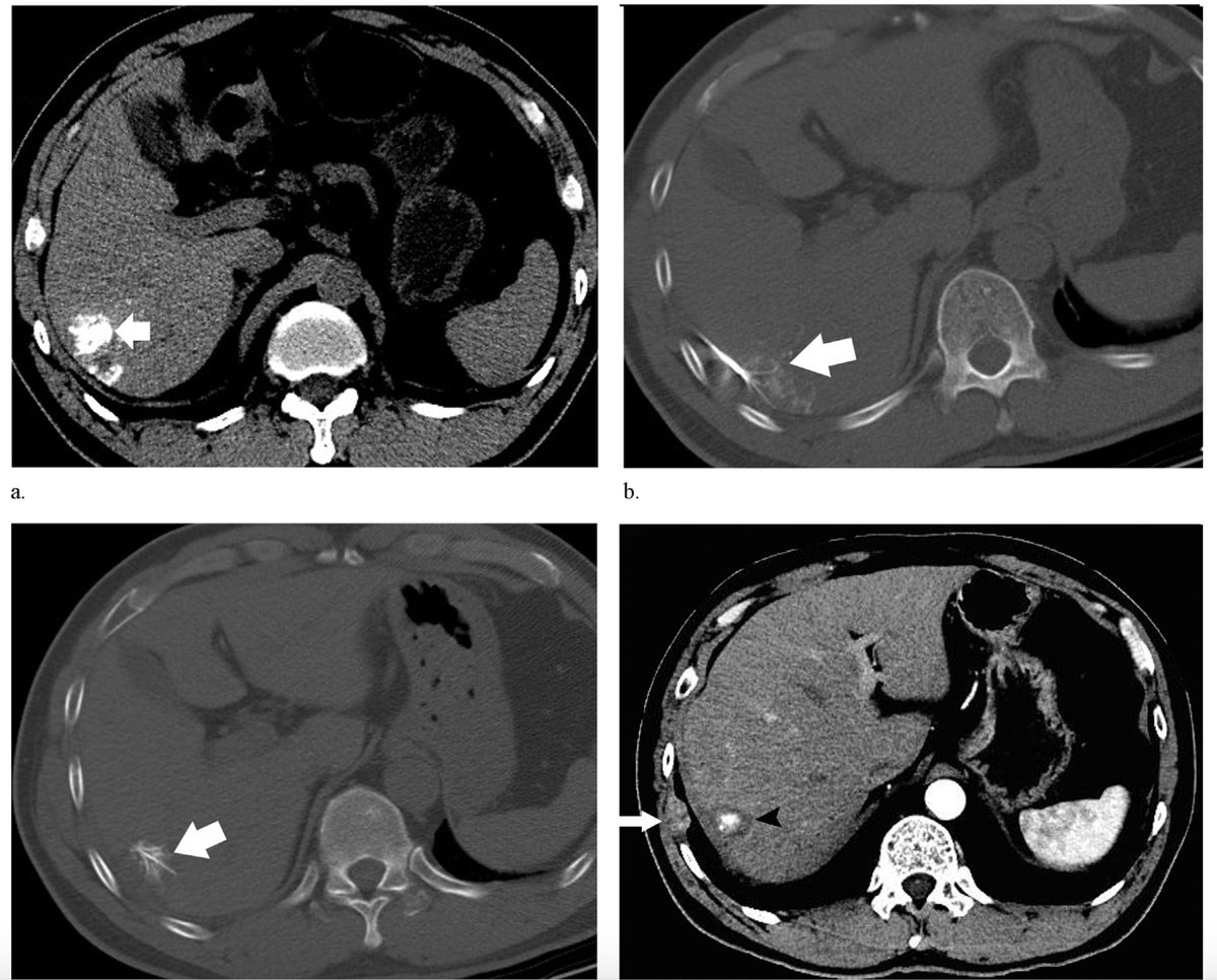 JVIRmedia's tweet photo. Safety &amp; Efficacy of #TACE Combined with CT-Guided RFA for Hepatocellular Carcinoma Adjacent to the Hilum | #iRad https://t.co/I8SNFzg8ig