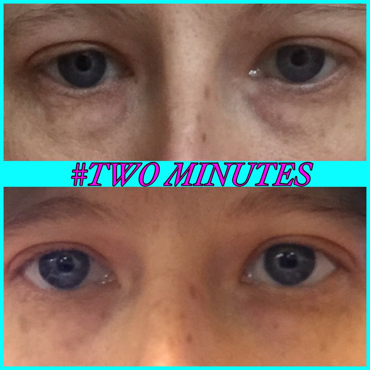Who wants their under eye bags gone in minutes?