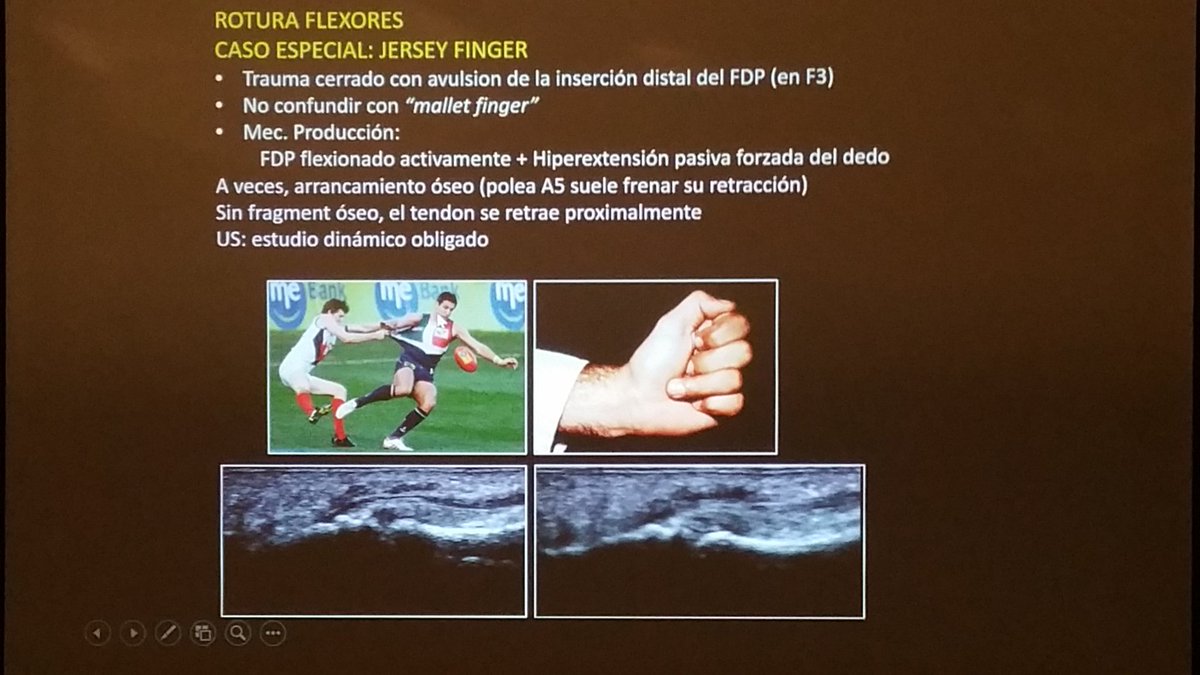 carlespedret's tweet image. Day 3 #ECOARS jersey finger. Injuries in the flexor tendons of the fingers.