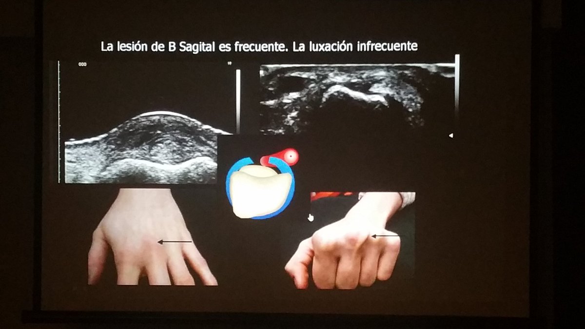 carlespedret's tweet image. Boxer's knuckle. Injury at the dorsal sagital band #ECOARS