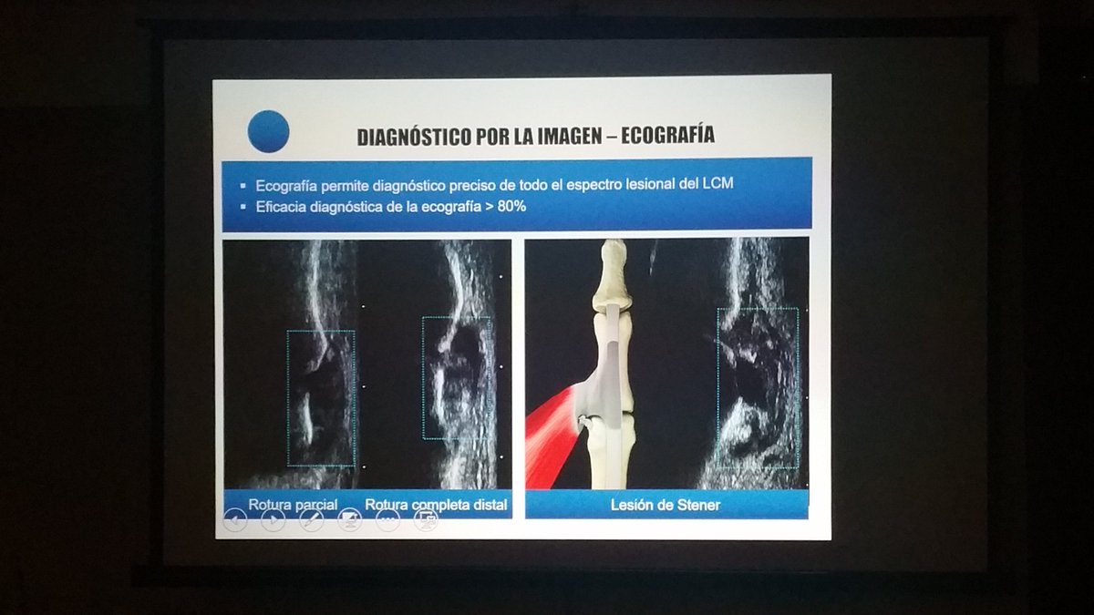 carlespedret's tweet image. Thumb UCL injuries #ECOARS Dr. Cerezal