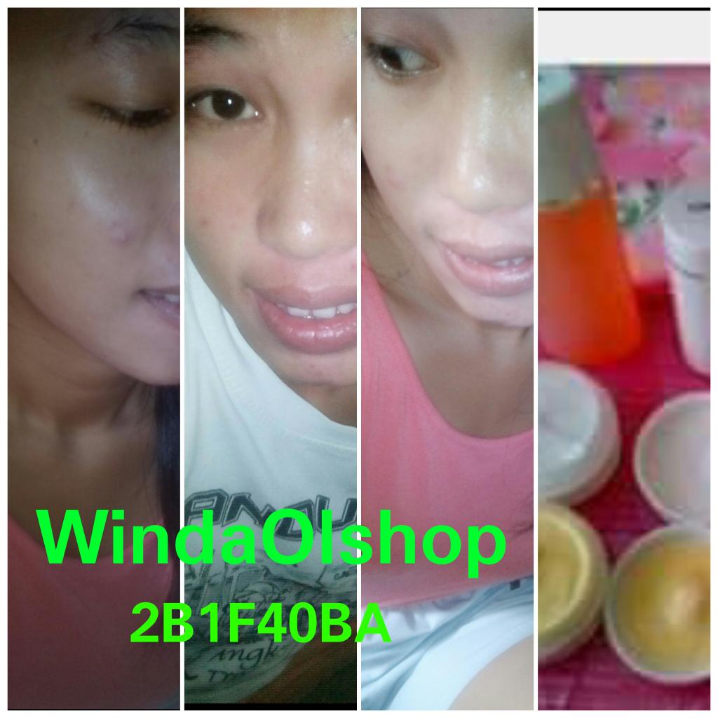 Ada masalah bagian wajah..jerawat,flek,komedo dan hitam,,yuux beralih ke cream HN Original,dijamin muka mulus 100%..