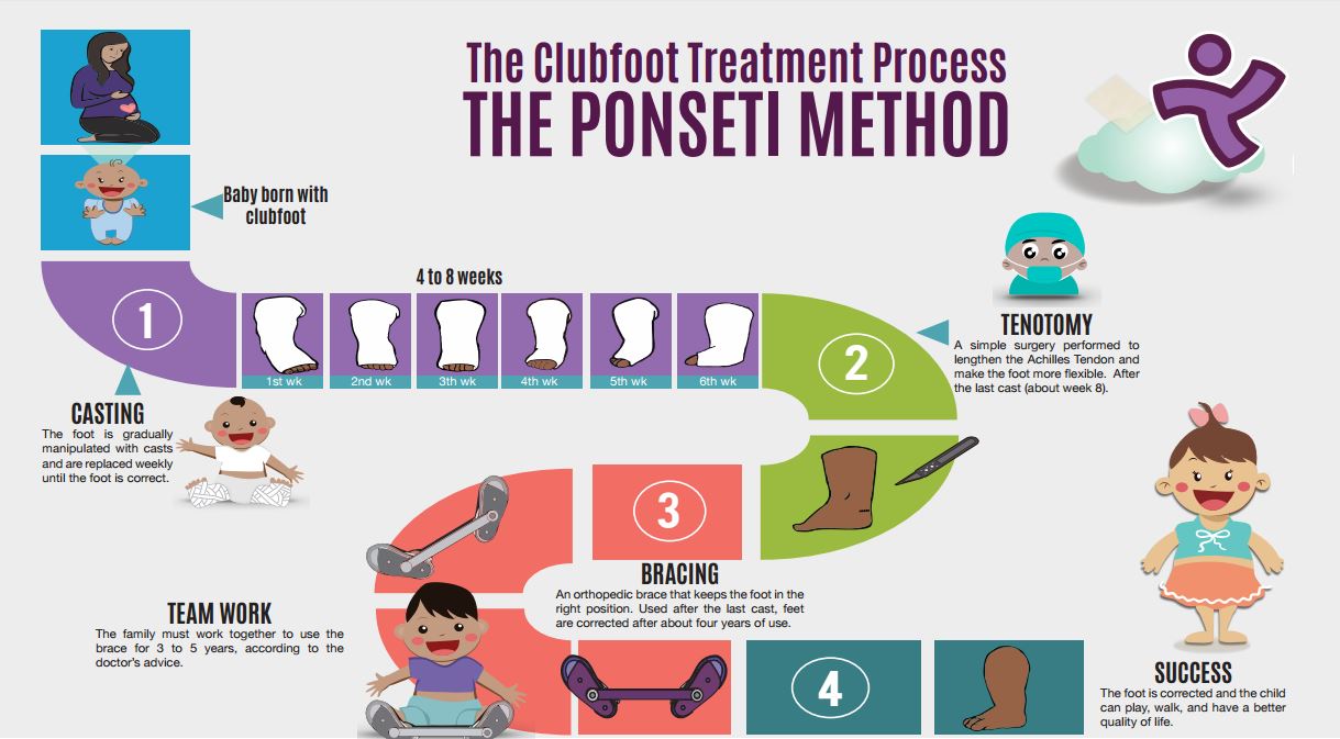 Miraclefeet On Twitter Are You Familiar With The Ponseti Method For Treating Clubfoot Https T Co Wchde7nu46