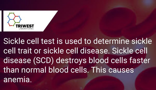 TriWestLabs's tweet photo. #SickleCellTest determines sickle cell #trait or sickle cell #disease. #SCD destroys #bloodcells faster than normal. https://t.co/994BtX5gg6