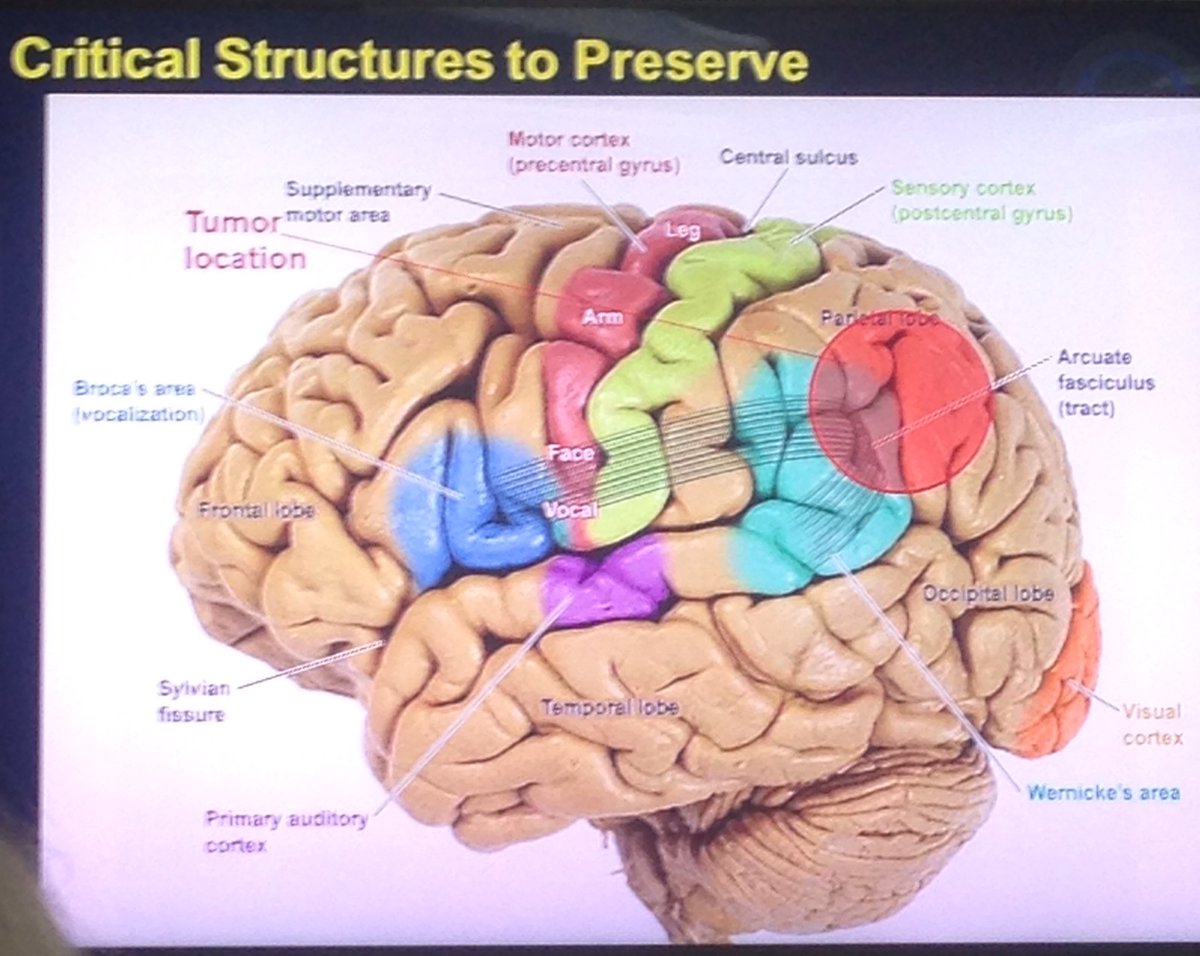 NoBrainCancer's tweet photo. Critical Structures to Preserve in surgery for brain tumor patients. -Dr Mitch Berger, UCSF #BTSM #IABTM #Cure https://t.co/QjdxWsawc7