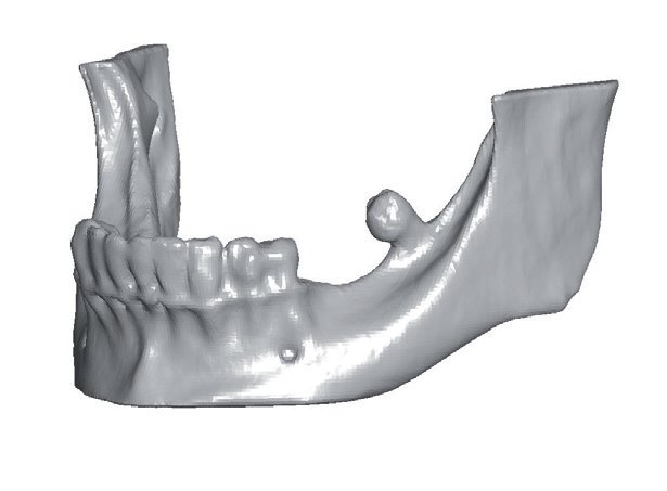 StraumannUK's tweet image. What is the @BotissB Maxgraft Bonebuilder? Find out here goo.gl/5BdATQ