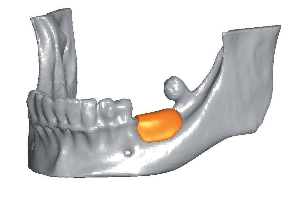 StraumannUK's tweet image. What is the @BotissB Maxgraft Bonebuilder? Find out here goo.gl/5BdATQ