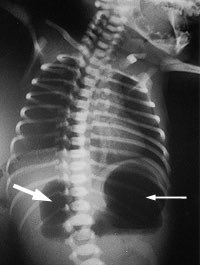 Medicine_Lovers's tweet photo. Double Bubble sign is highly suggestive of DUODENAL ATRESIA
#USMLE
#Med_Notes https://t.co/KBaG4rU5pS