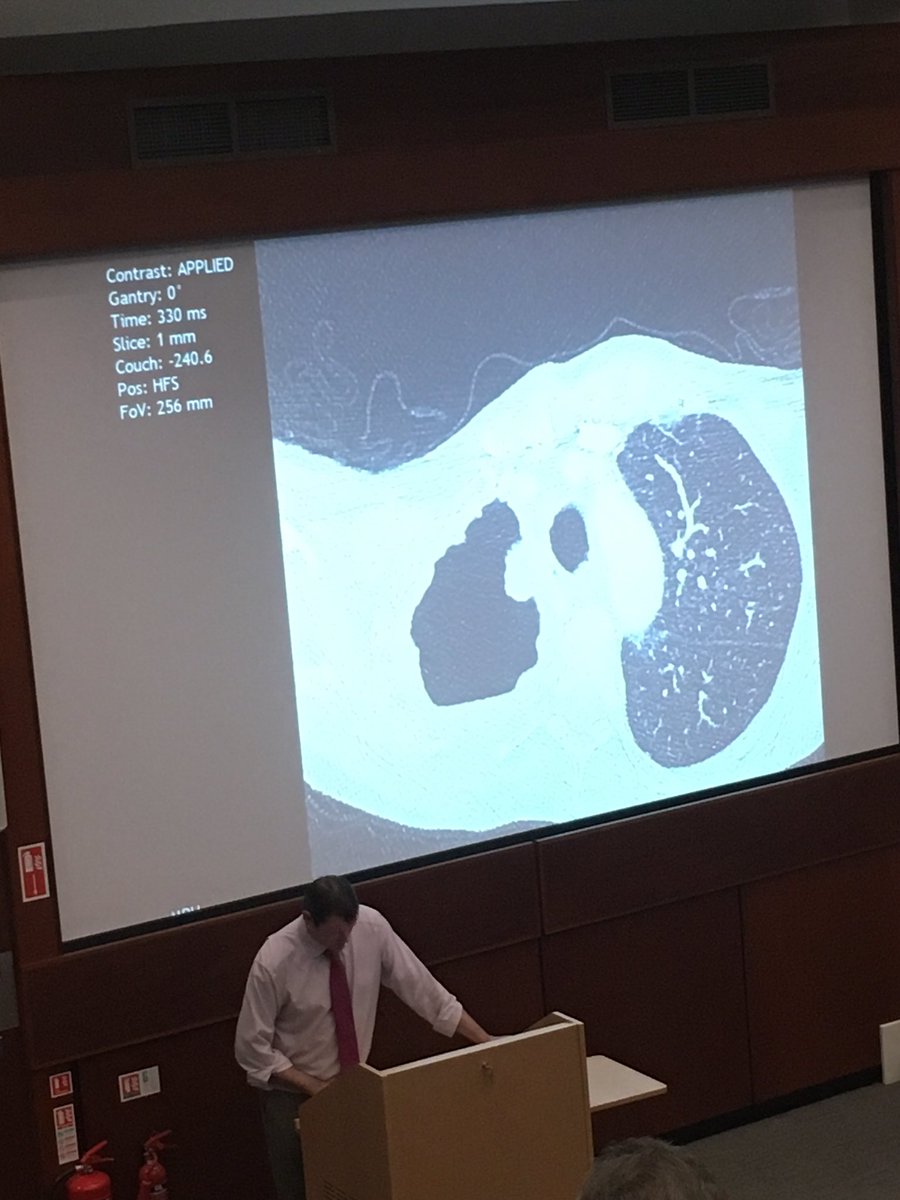 DamianFog's tweet photo. @BelfastTrust Belfast City Hospital physicians' meeting. Case of single right upper lobe lung cavity #MedEd https://t.co/7wa1IG4w43