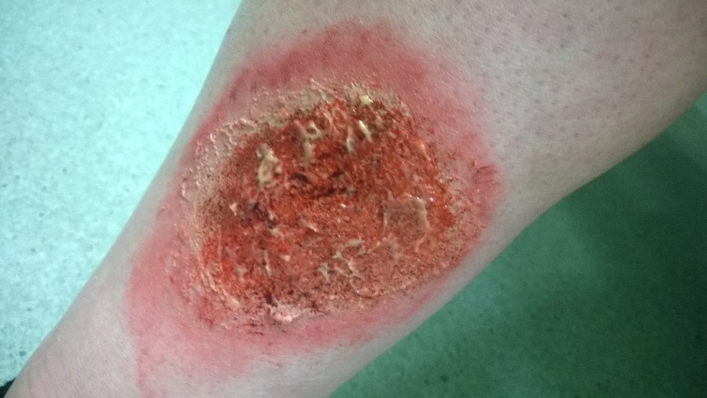 WhKatrina's tweet photo. 2nd year student nurses learn about leg ulcer holistic care with fab simulated ulcers @RGUCSC @RGUNursing #nursing https://t.co/cs78VGsQbt